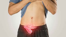 Qué son las hernias inguinales, cuáles son sus síntomas y cuándo es urgente una intervención quirúrgica