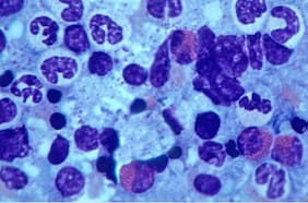 Identifican células inmunes que mejoran la eficacia de las vacunas contra el cáncer