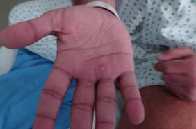 Fact Checking: ¿Viruela del mono puede permanecer por años en la piel de las personas? ¿La OMS dice que enfermedad se contagia por transfusiones de sangre?