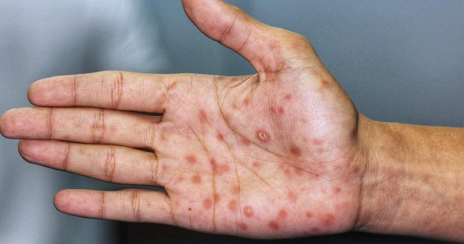 Cuando la sífilis no es tratada de forma temprana reaparece con síntomas como sarpullidos en las extremidades, las palmas de las manos y las plantas de los pies.