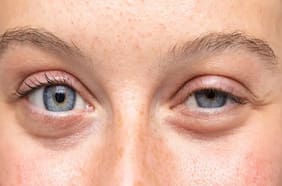 Cuando uno o ambos párpados están caídos: qué es la ptosis palpebral y cómo se puede tratar