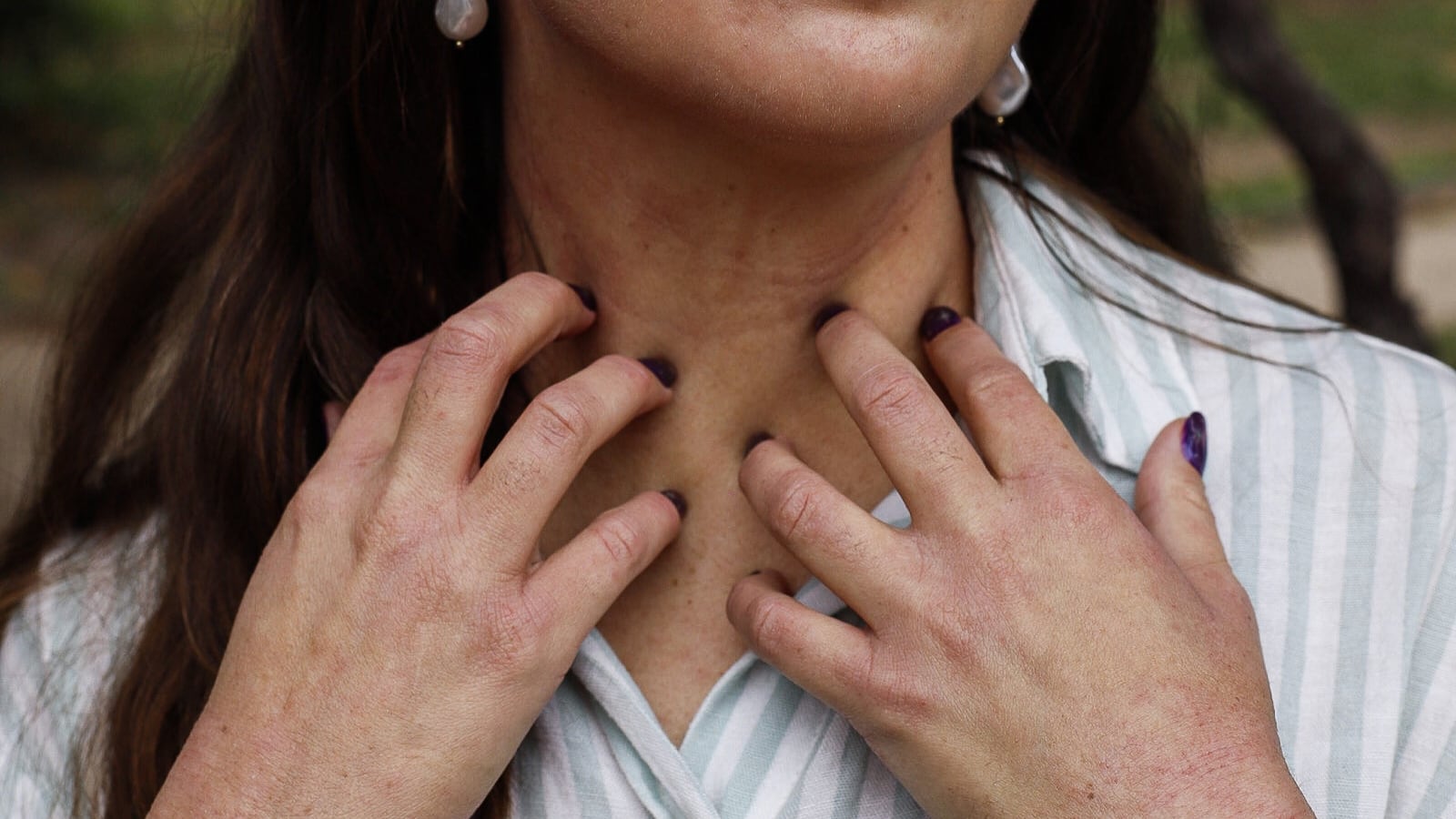 Vivir con dermatitis atópica