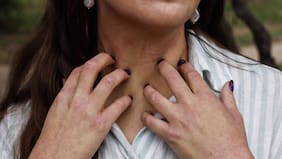 Vivir con dermatitis atópica
