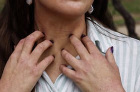 Vivir con dermatitis atópica