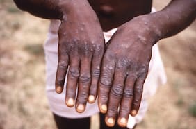Cuáles son los síntomas y cómo se contagia el mpox (antes viruela del mono)