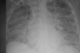 Radiografía muestran cómo pulmones de persona no vacunada infectada con Covid se llenan con el virus mientras que lo de una vacunada están libre de la enfermedad