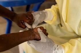 Las razones por las que el brote de Mpox en África podría convertirse en la próxima pandemia mundial