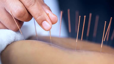 Cómo la acupuntura puede “reconfigurar” el cerebro de las personas con depresión, según un estudio