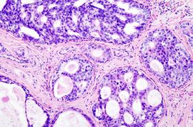 Cáncer de mama triple negativo: Personas diagnosticadas promedian 55 años