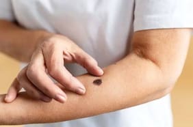 Radar LT | IA sin sesgos: tecnología justa para el diagnóstico de cáncer de piel en el norte de Chile