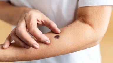 Radar LT | IA sin sesgos: tecnología justa para el diagnóstico de cáncer de piel en el norte de Chile