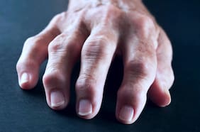 Un tratamiento contra el cáncer logró una remisión de la artritis reumatoide grave, según un estudio