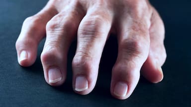 Un tratamiento contra el cáncer logró una remisión de la artritis reumatoide grave, según un estudio