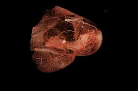 La detección precoz es fundamental: cáncer de mama entre los 3 más mortales de Chile