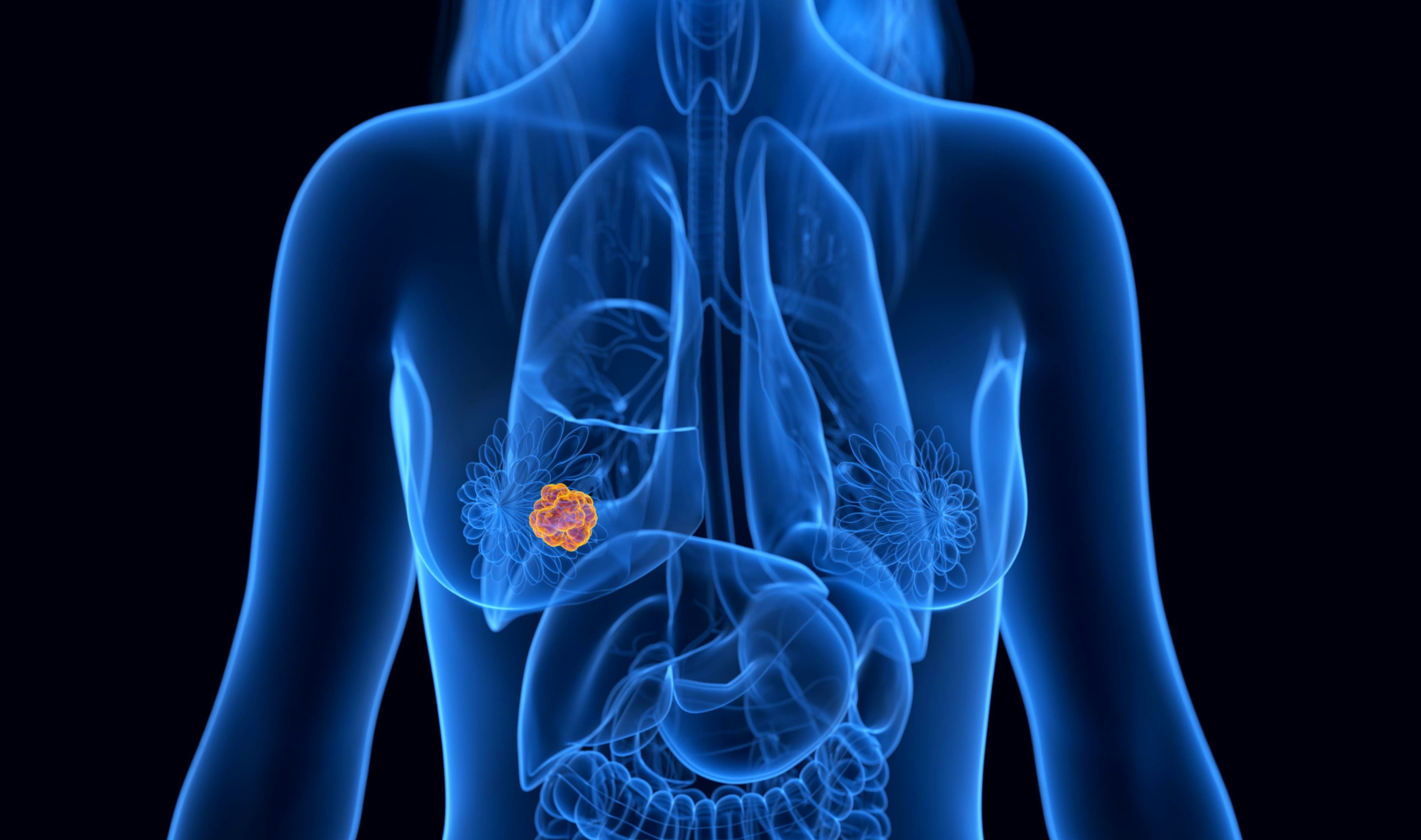 Cáncer de mama: cuáles son los síntomas, las señales de alerta y los tratamientos disponibles. Foto: referencial.