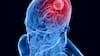Científicos desarrollan un tratamiento con azúcar contra la forma más agresiva de cáncer cerebral