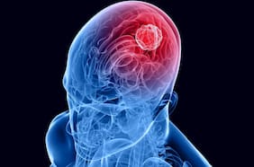 Científicos desarrollan un tratamiento con azúcar contra la forma más agresiva de cáncer cerebral
