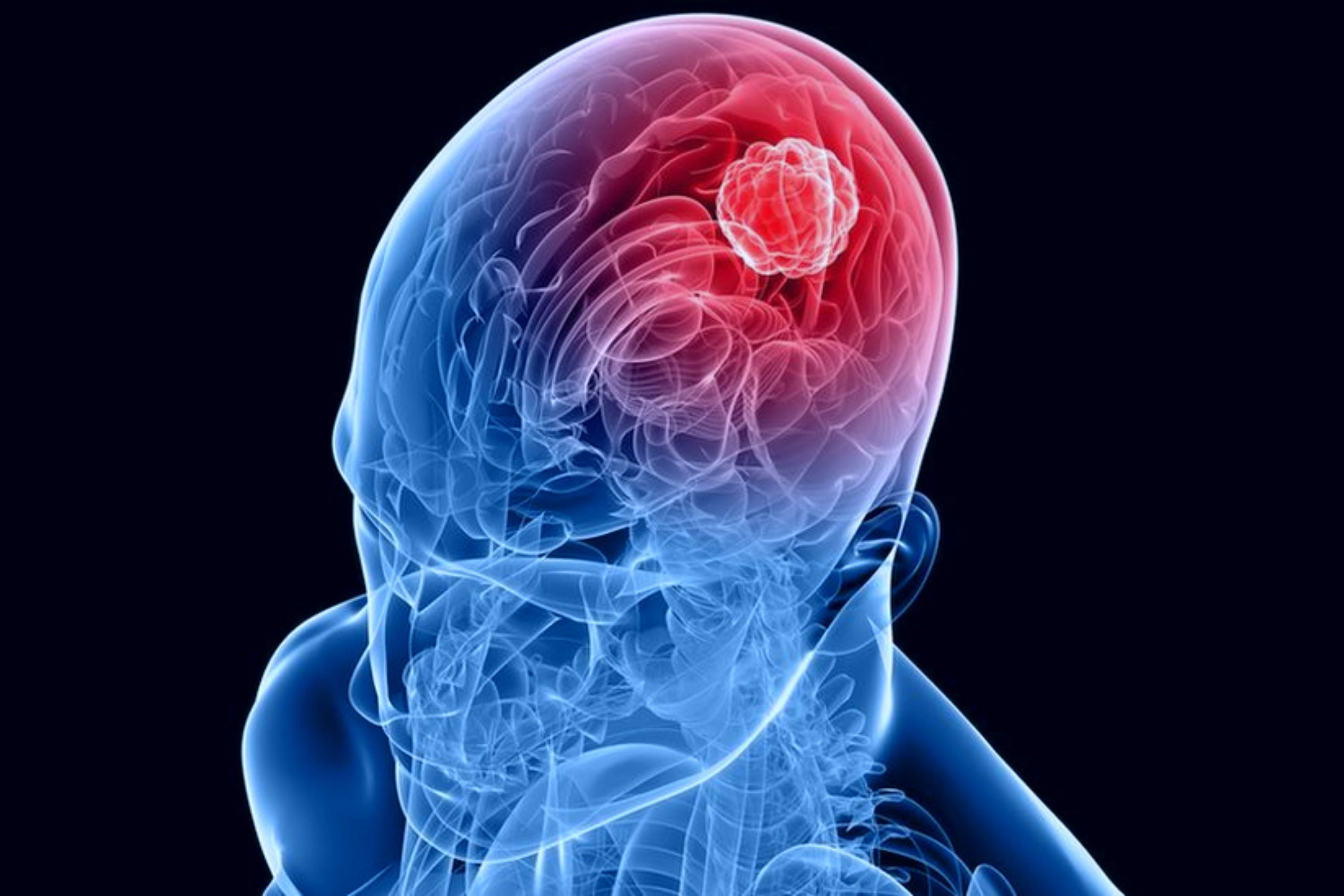 Científicos desarrollan un tratamiento con azúcar contra la forma más agresiva de cáncer cerebral