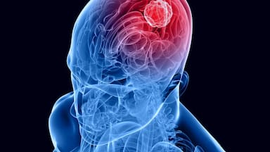 Científicos desarrollan un tratamiento con azúcar contra la forma más agresiva de cáncer cerebral