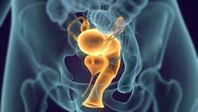 El alimento vinculado a un mayor riesgo de cáncer de próstata, según distintos estudios