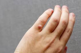 Esto es lo que debes saber si te sale una verruga