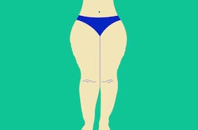 Lipedema: El dolor de acumular grasa