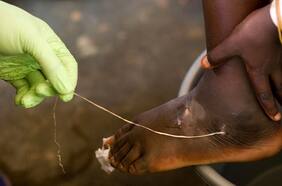 El fin del temible gusano de Guinea está más cerca: casos se reducen a la mitad en un año
