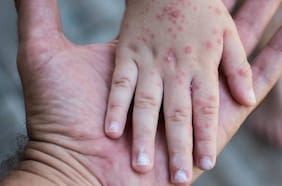 Minsal en alerta por bajas coberturas en vacuna contra sarampión: segunda dosis alcanza solo un 65,7%