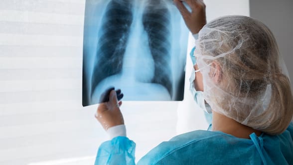 Qué es la tuberculosis, la enfermedad que continúa circulando en Chile y que afectó a un estudiante en Concepción