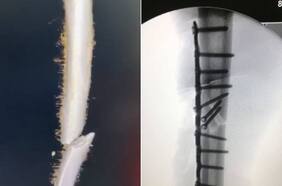 Marc Márquez comparte el antes y después de su operación por una fractura