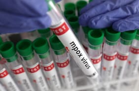 Mpox sigue presente en Chile, pero con drástica reducción: de 1.402 casos el primer año a 186 en 2025