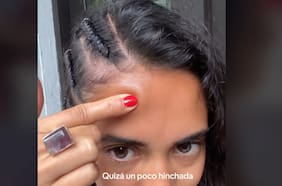 “Tenía un tubérculo en la cabeza”: turistas alertan peligrosa reacción tras hacerse trenzas en Brasil
