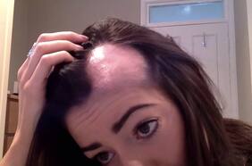 ¿Puede cualquier persona sufrir alopecia areata, la enfermedad que padece Jada Pinkett, esposa de Will Smith?