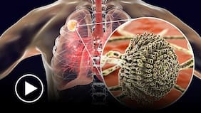 El nuevo mecanismo que reduce el daño pulmonar y las infecciones severas