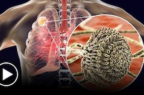 El nuevo mecanismo que reduce el daño pulmonar y las infecciones severas