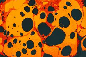 La FDA aprueba primera terapia celular para el melanoma avanzado