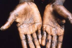 Detectan primer caso sospechoso de viruela del mono en la Argentina