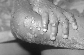 ¿Cuál es la probabilidad de contraer el virus?