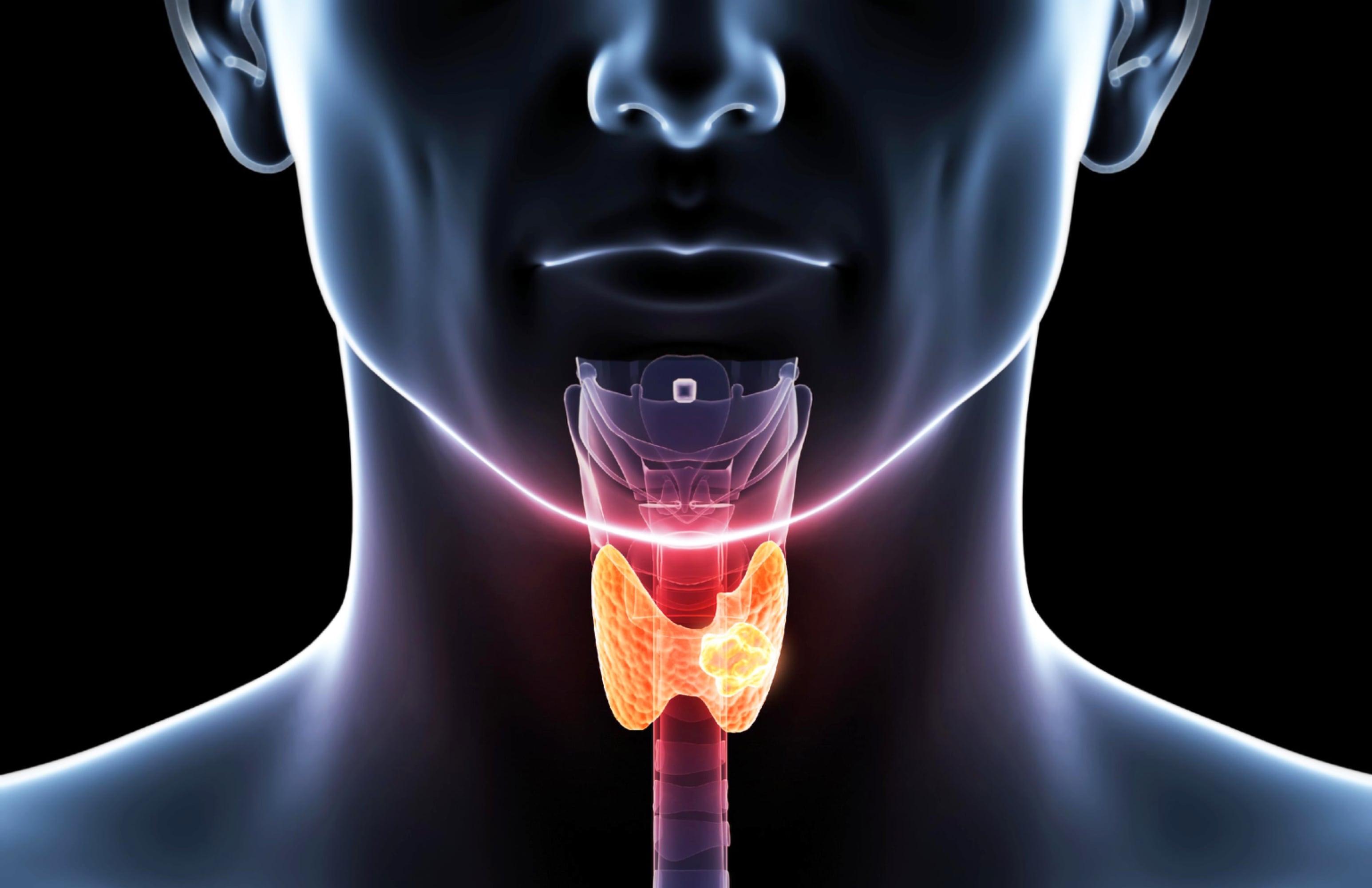 Cáncer de tiroides: qué es y cuáles son los factores de riesgo y las señales de alerta
