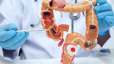 Cómo las células del cáncer de colon pueden cambiar de identidad para propagarse, según una investigación