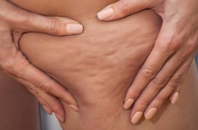 3 recomendaciones de expertos para tratar la celulitis
