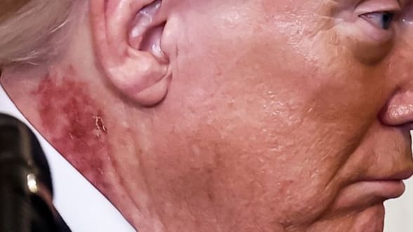 Qué dijo el médico de Donald Trump por la extraña mancha roja del presidente en su cuello
