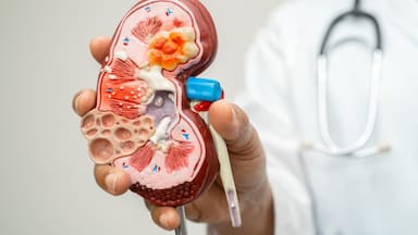 Por qué está aumentando el número de pacientes con enfermedad renal, según un estudio