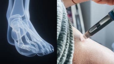 Las inyecciones de GLP-1 pueden aumentar el riesgo de lesiones en huesos, según un reciente estudio