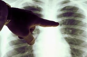 Aumentan casos de cáncer de pulmón en personas que nunca han fumado y un estudio descubre por qué
