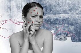 Trastorno por excoriación: cuando rascarse la piel se convierte en una obsesión