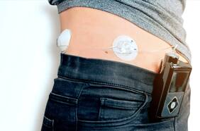 El páncreas artificial que podría ayudar a pacientes con diabetes tipo 2