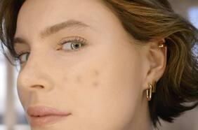 Manchas en la piel: cómo surgen, tratarlas y prevenirlas