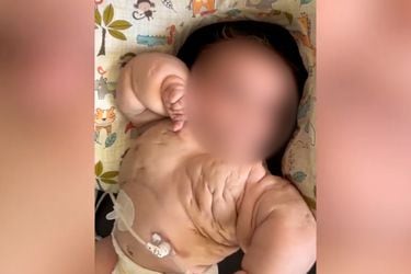 Baby hulk: Niña nace con rara enfermedad que hincha sus brazos y pecho