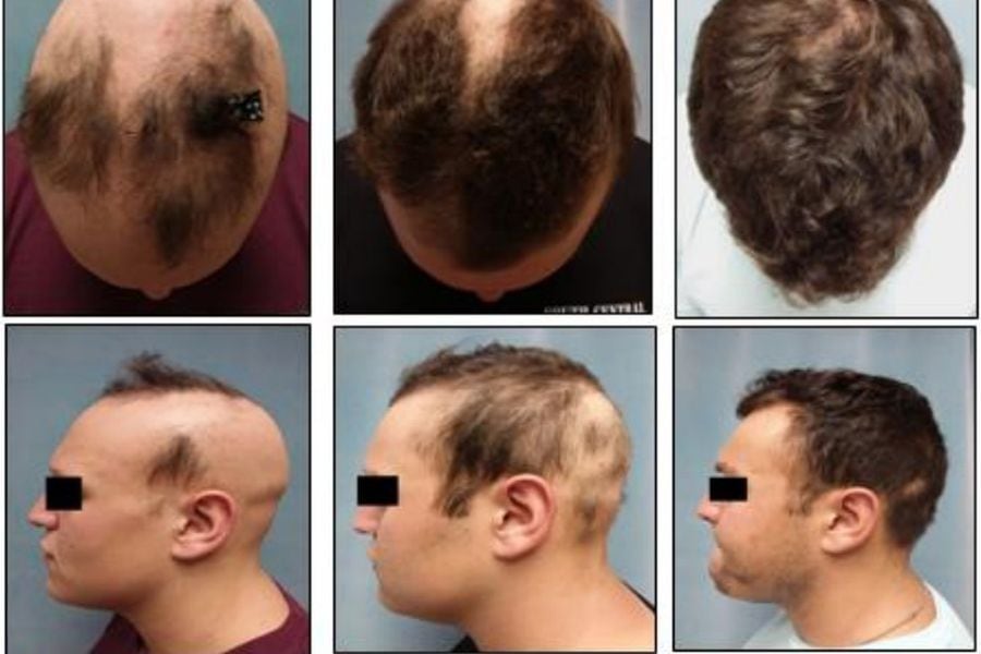 obra maestra Él Adelante Nueva y prometedora pastilla para la calvicie: casi la mitad de los  pacientes recuperaron 80% de su cabello tras un año - La Tercera